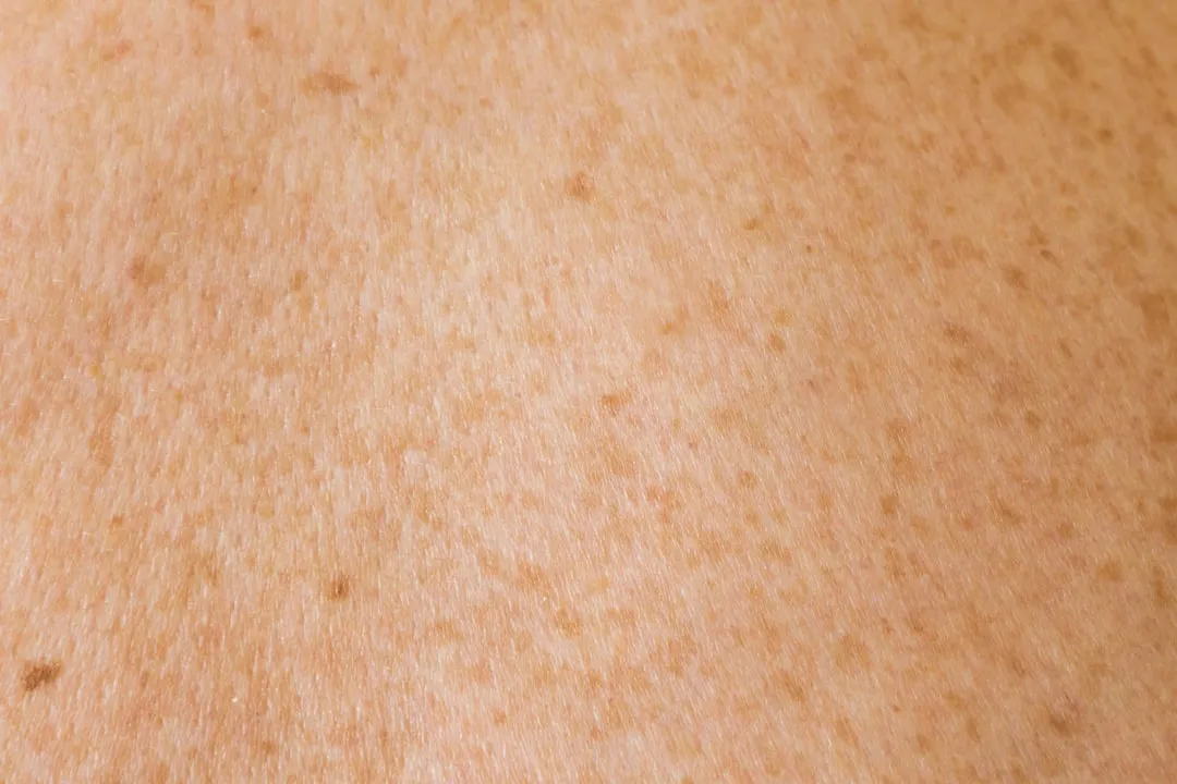 a close up of a person's back with brown spots